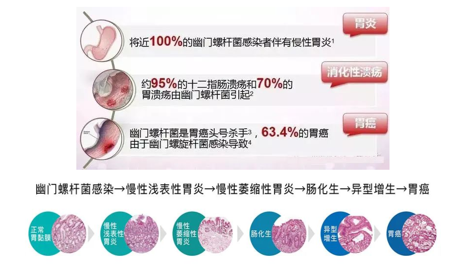 幽門螺旋桿菌的危害