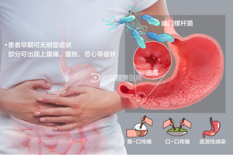 幽門螺旋桿菌感染檢查