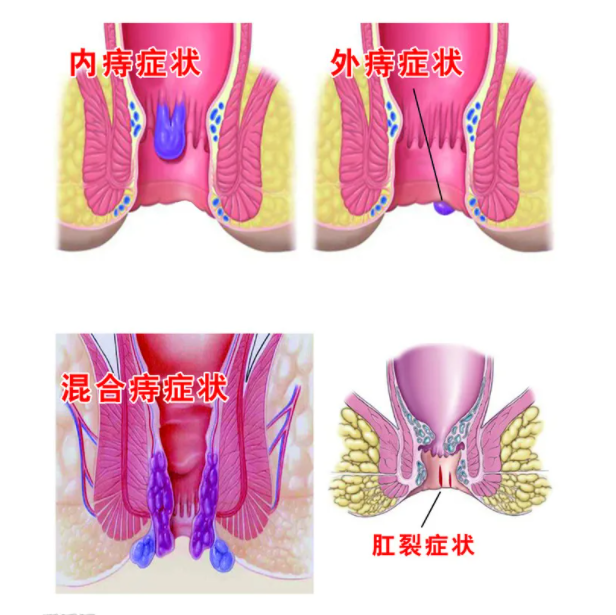 昆明肛腸疾病檢查醫(yī)院-電子肛門鏡檢查