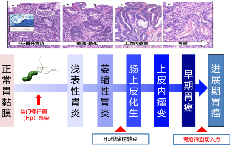 胃癌，大部分都是拖出來(lái)的？這些胃病需及時(shí)治療！