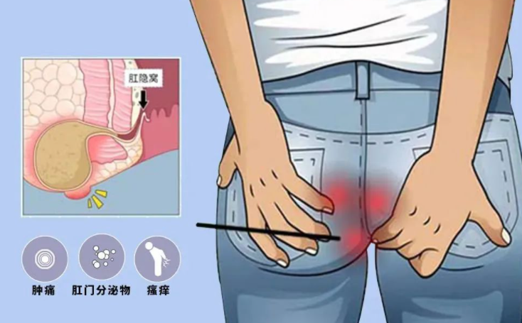 肛周膿腫拖不得！當(dāng)心肛瘺緊隨其后！