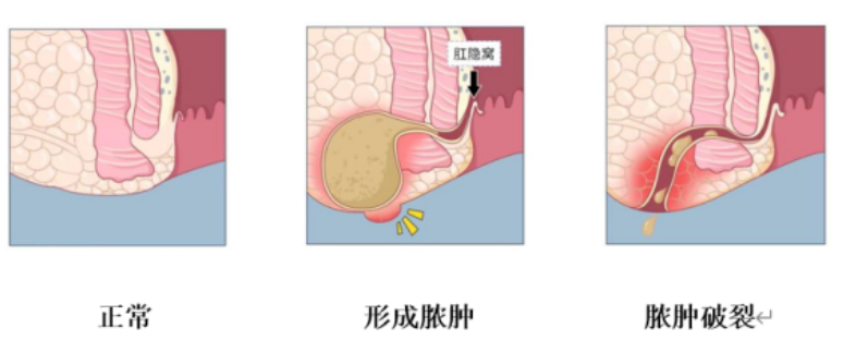 屁屁上紅腫長(zhǎng)包？小心肛周膿腫，千萬別拖延，應(yīng)盡快就醫(yī)！